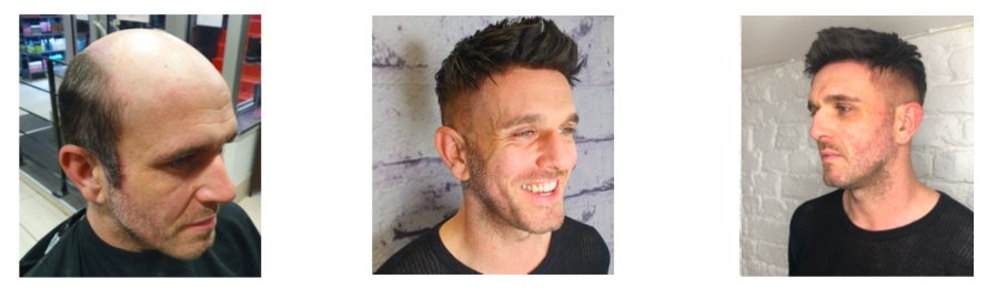 Mens Hair Replacement Liverpool